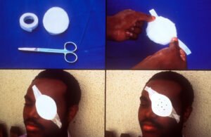 The Eye Guard Rule: Safety First in Pickleball